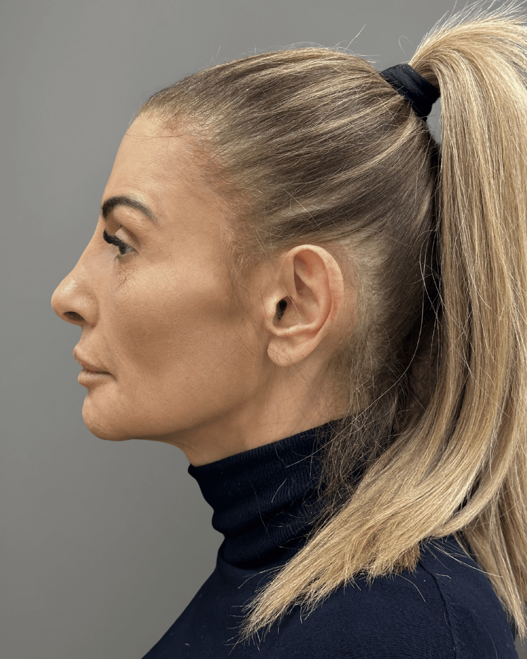 Ляв профил след ринопластика – резултат след операция на носа