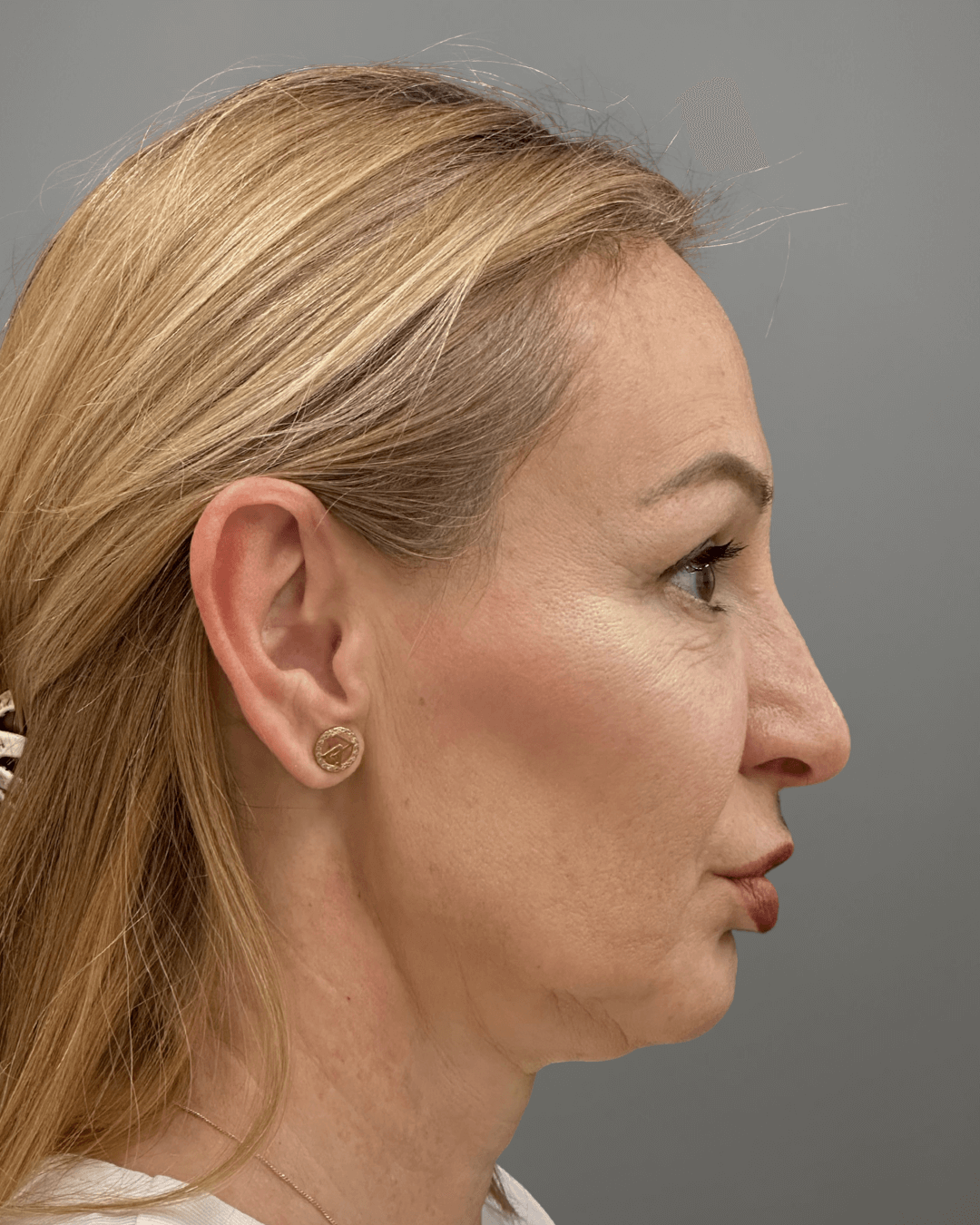 Десен профил преди ринопластика