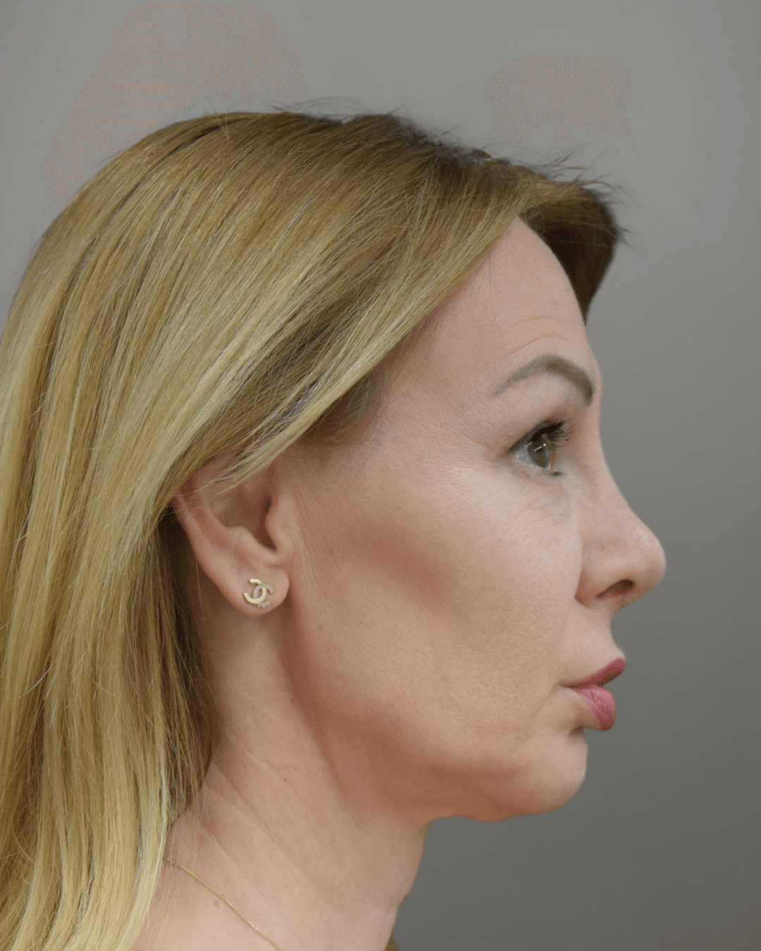 Десен профил след ринопластика – резултат от операция на носа