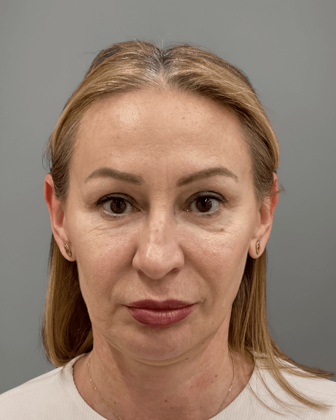 Фронтален изглед преди ринопластика