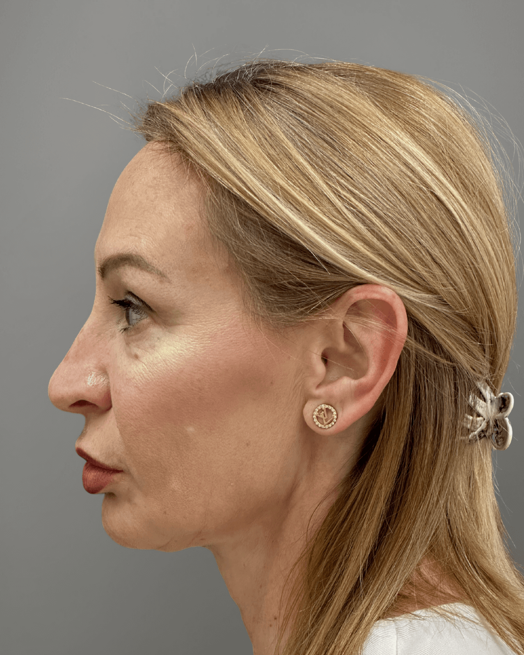 Ляв профил преди ринопластика – предоперативен изглед на носа