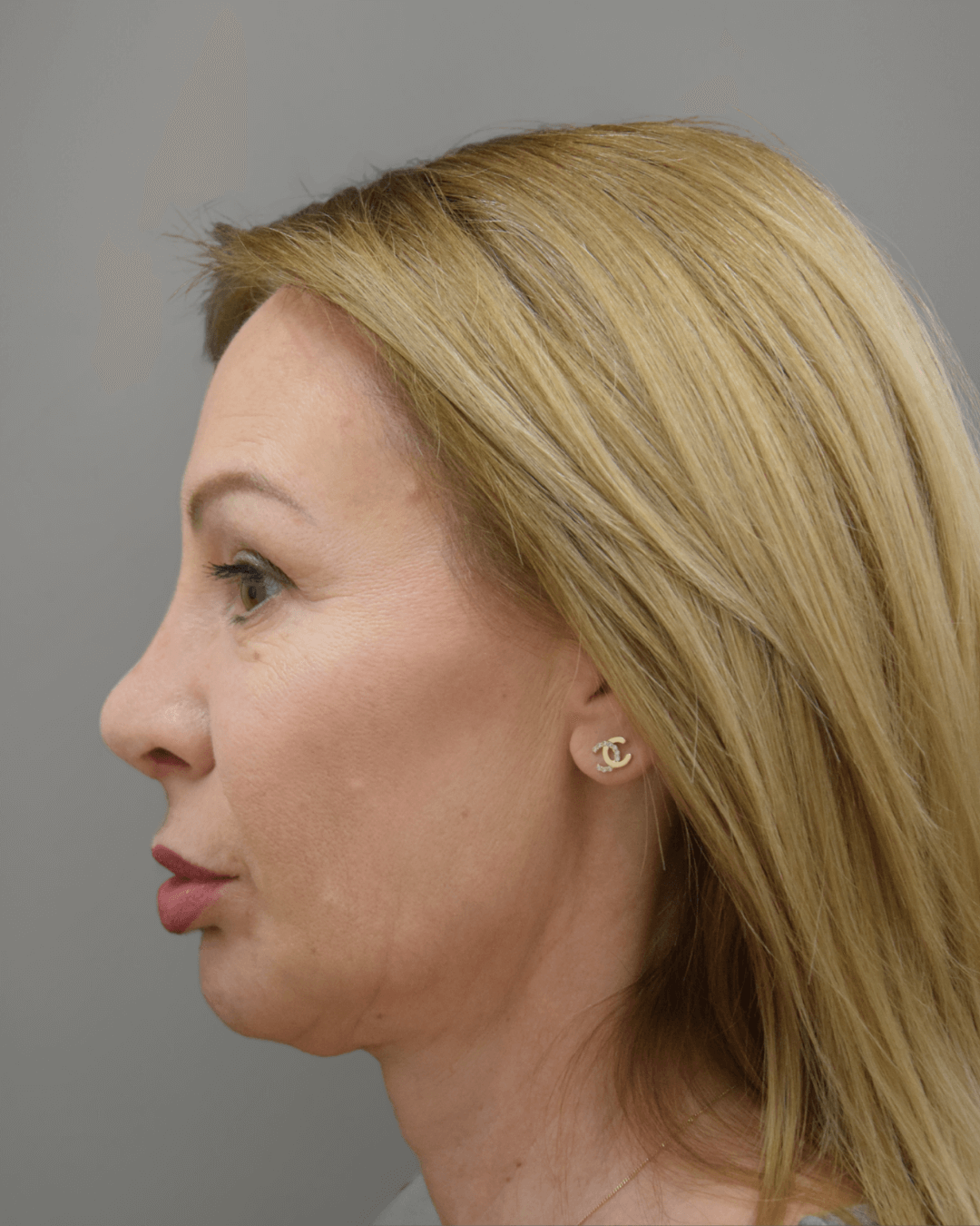 Ляв профил след ринопластика – резултат след операция на носа